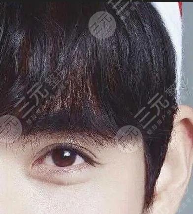中大醫(yī)院割雙眼皮案例分享