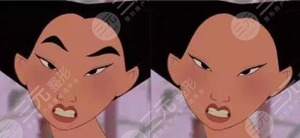 激光洗眉后1至7天的變化圖貼出，短短一周能恢復(fù)到什么程度？果嗎？