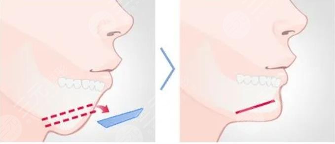 女人后縮下頜角整形優(yōu)勢