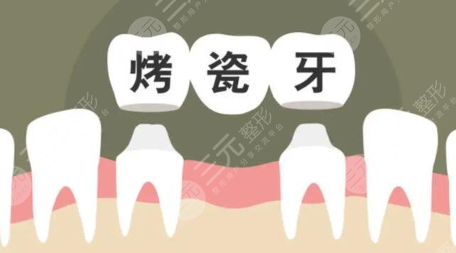 烤瓷牙多少錢一顆價格表2022全國，烤瓷牙壽命可以保持幾年？收藏不虧！