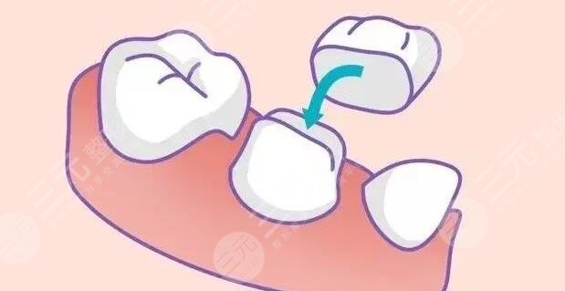 烤瓷牙多少錢一顆價格表2022