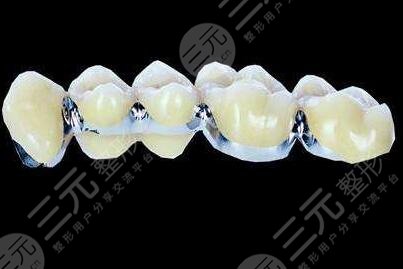 烤瓷牙能保持幾年壽命？