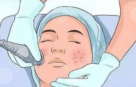 激光去痘坑多少錢