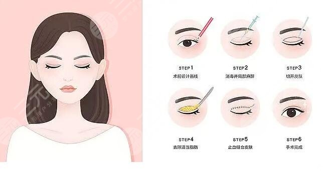 常州市第一人民醫(yī)院整形燒傷科雙眼皮手術(shù)整形案例