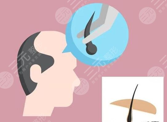 植發(fā)手術的費用影響因素：