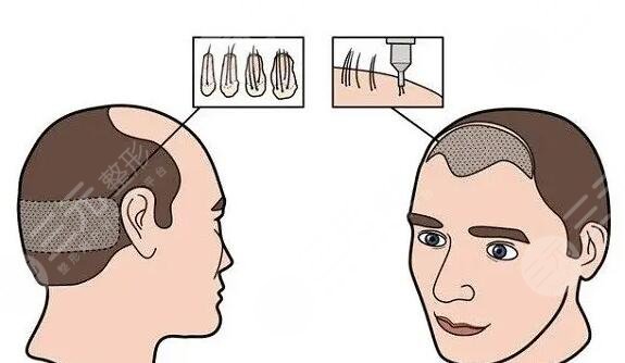 植發(fā)手術有哪些需要注意的?