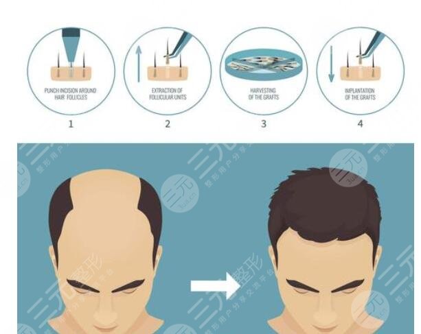 植發(fā)手術怎么護理?