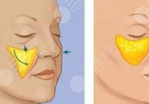 自體脂肪豐蘋果肌果好嗎?