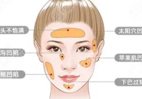 自體脂肪豐蘋果肌果好嗎?