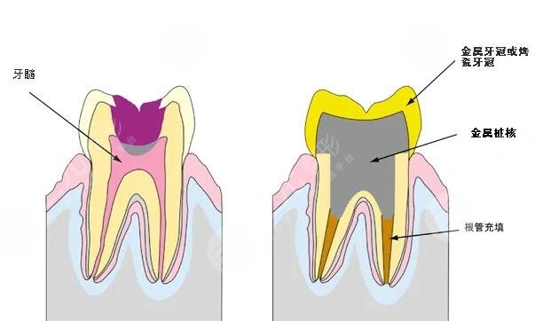 根管緩解持時間是多久？