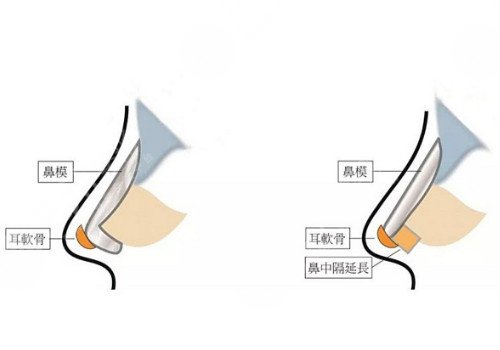 自體軟骨隆鼻多少錢？