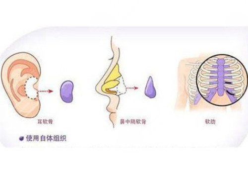 自體軟骨隆鼻多少錢？