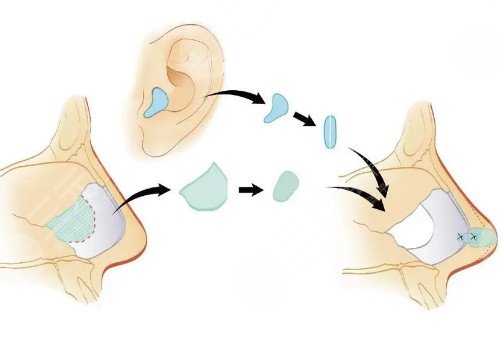 自體軟骨隆鼻多少錢？