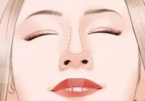 自體軟骨隆鼻多少錢？