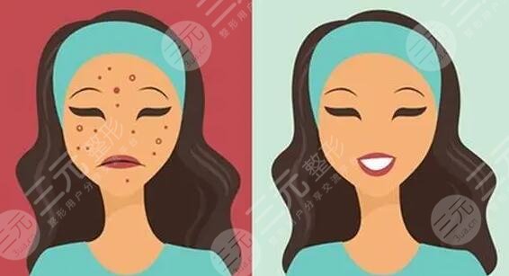 　　臉上的痘坑怎么去掉?隨著年齡的增長(zhǎng)，不少人臉上都出現(xiàn)了青春痘或者是長(zhǎng)痘的情況，這些多數(shù)是由內(nèi)分泌失調(diào)和皮膚油脂平衡失調(diào)造成的，首先在發(fā)現(xiàn)自己長(zhǎng)痘之后，就需要通過正規(guī)的祛痘手術(shù)去除痘痘才行，如果是不正規(guī)的方法就容易造成痘坑、痘印，對(duì)于小伙伴們來說，痘坑痘印比痘痘更讓人難受，目前國(guó)內(nèi)可以去痘坑的方法有很多，都是國(guó)內(nèi)祛痘坑成功的小伙伴們選擇的技術(shù)手段，下面就有小編一一來為大家做一個(gè)介紹!  　　1、臉上的痘坑怎么去掉更有?  　　(1)、激光祛痘坑，利用高熱能量的激光，在皮膚表面進(jìn)行照射，光能對(duì)痘坑位置有一定的刺激作用，能夠刺激膠原蛋白的再生和膠原纖維的修復(fù)生長(zhǎng)，從而達(dá)到修復(fù)痘坑的果。  　　(2)、果酸換膚，果酸換膚主要是在痘坑皮膚表面涂抹果酸，利用專業(yè)的器械設(shè)備刺激手術(shù)部位的皮膚細(xì)胞再生，加速痘坑區(qū)域的新陳代謝來達(dá)到去除痘坑，讓皮膚看起來光滑平整的手術(shù)果。  　　(3)、微針緩解，微針緩解是很多美容院都會(huì)采取的一種改良痘坑的方法，能夠?qū)⒍豢游恢玫钠つw層次重新進(jìn)行疏通，輸入一定的營(yíng)養(yǎng)物質(zhì)，使皮膚的修復(fù)能力上線來達(dá)到去除痘印的果。  　　(4)、填充祛除，填充的技術(shù)手段所針對(duì)的是痘坑，比較嚴(yán)重的人群，特有的一種技術(shù)方法，將專業(yè)的填充材料填充到痘坑凹陷比較嚴(yán)重的位置來讓痘坑平整。  　　(5)、DIY面膜，如果是針對(duì)于痘坑比較淺或者是新出現(xiàn)的痘坑的話，可以通過護(hù)膚品等方式來讓自己的痘坑有一定的修復(fù)果，其中比較受求美者喜歡的是蛋清珍珠粉，面膜蛋清和珍珠粉融合之后涂抹在面部一5到20分鐘左右，用清水清洗一周敷兩次左右，一段時(shí)間之后可以有一定淡化痘坑的果。  　　2、激光祛痘印痘坑多少錢?  　　激光去除痘坑痘印的價(jià)格通常在2千到一萬元不等，首先緩解面積是影響價(jià)格的關(guān)鍵，如果是小面積的痘坑，那么它的手術(shù)難度就比較小，費(fèi)用也會(huì)比較便宜，但如果是面積較大且又深的痘坑的話，那么它的收費(fèi)價(jià)格就會(huì)在8000元及以上。當(dāng)然醫(yī)院的選擇和地區(qū)的選擇也會(huì)影響到價(jià)格，3甲醫(yī)院的收費(fèi)要比2甲醫(yī)院更貴，私立的整形醫(yī)院和普通的門診部的收費(fèi)標(biāo)準(zhǔn)也有一定的區(qū)別，一線城市和3線城市的醫(yī)療標(biāo)準(zhǔn)也有較大的不同。除了以上兩點(diǎn)以外醫(yī)生的選擇其實(shí)也會(huì)影響到價(jià)格收費(fèi)情況，實(shí)習(xí)醫(yī)生和的祛痘坑醫(yī)生，它的收費(fèi)標(biāo)準(zhǔn)都是不一樣的。  　　3、激光去痘坑要做幾次?  　　一般情況下，激光去痘坑要做3到5次時(shí)間，它主要是通過皮膚表層深入到皮膚層，為此促進(jìn)皮膚膠原蛋白的再生來改良痘坑問題，但每一個(gè)人的實(shí)際情況是不一樣的，如如果是痘坑比較淺的求美者的話。那么他的激光祛痘坑3次就可以有良好的改良果，反之則要五次。  　　4、微晶磨皮和點(diǎn)陣激光哪個(gè)比較好?  　　這之間都是激光的一種，都可以運(yùn)用到去除疤痕，去除痘坑，去除皺紋，上面不同點(diǎn)在于兩者所使用的材料是不一樣的點(diǎn)，點(diǎn)陣激光采用的是超脈沖和激光掃描，兩者結(jié)合在一起，微晶磨皮則采用的是氫化硅晶體，作為求美者，建議可以直接到醫(yī)院，讓醫(yī)生根據(jù)你的實(shí)際情況給你定制相對(duì)應(yīng)的美容方法，這樣才能有良好的祛痘坑果。