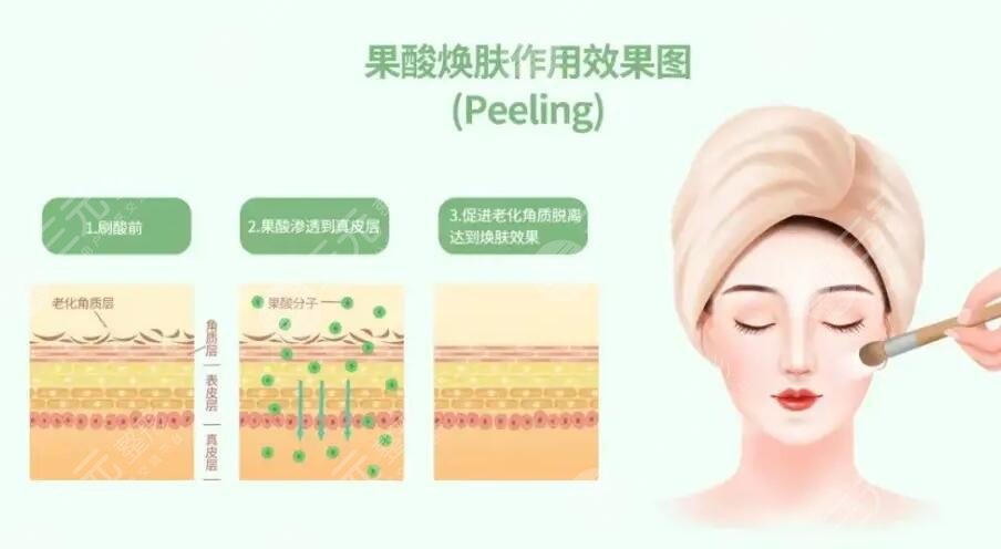 果酸換膚