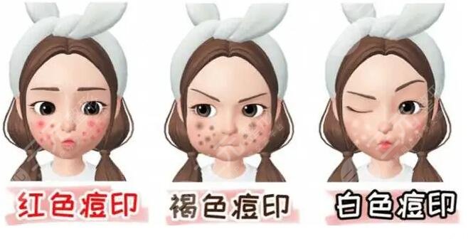 激光祛痘印痘坑多少錢?