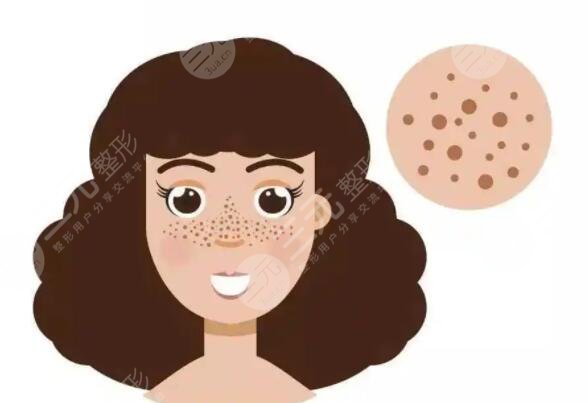 激光去痘坑要做幾次?