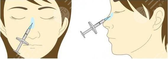 注射隆鼻需要注意什么問題?