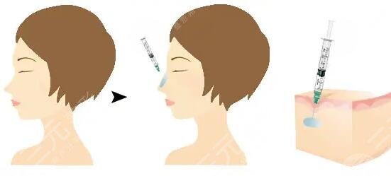 注射隆鼻需要注意什么問題?