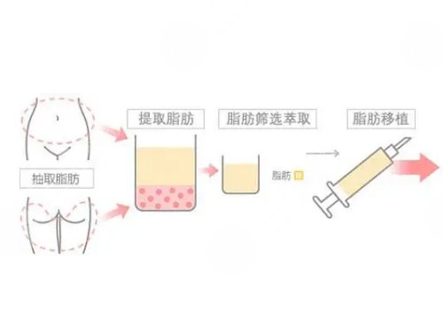 面部自體脂肪填充可以維持多久？