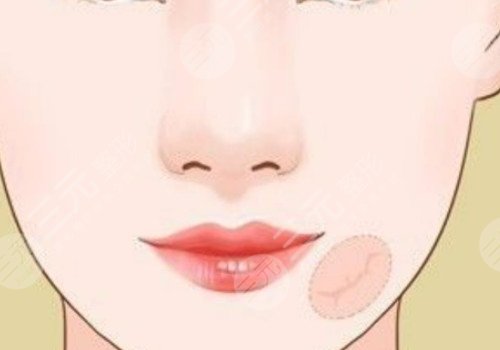 如何祛除臉上的疤痕?