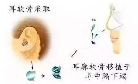 自體軟骨隆鼻果可以維持多久？