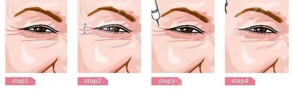 去除魚(yú)尾紋有副作用嗎?