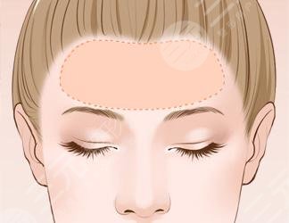 面部自體脂肪填充可以維持多久？