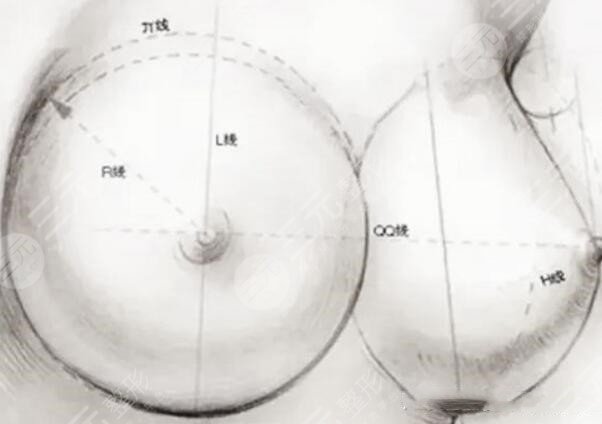 假體隆胸手術(shù)的原理是什么?