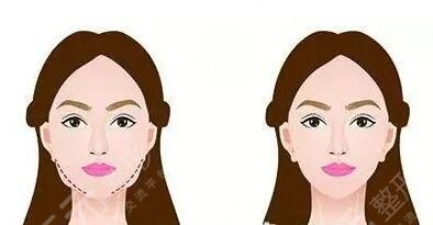 下頜角肥大矯正術(shù)術(shù)后并發(fā)癥有哪些？