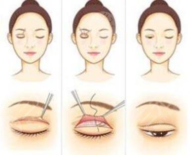 雙眼皮修復(fù)