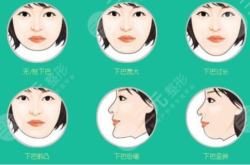 膨體隆下巴的術(shù)后護(hù)理