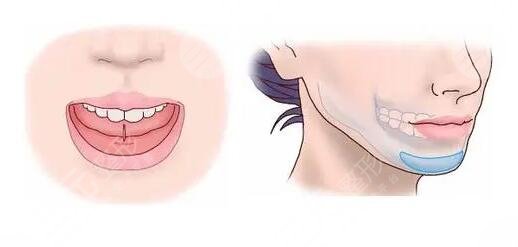 隆下巴假體恢復(fù)過(guò)程圖整理！隆下巴的手術(shù)過(guò)程是怎樣的？注意事項(xiàng)有哪些？