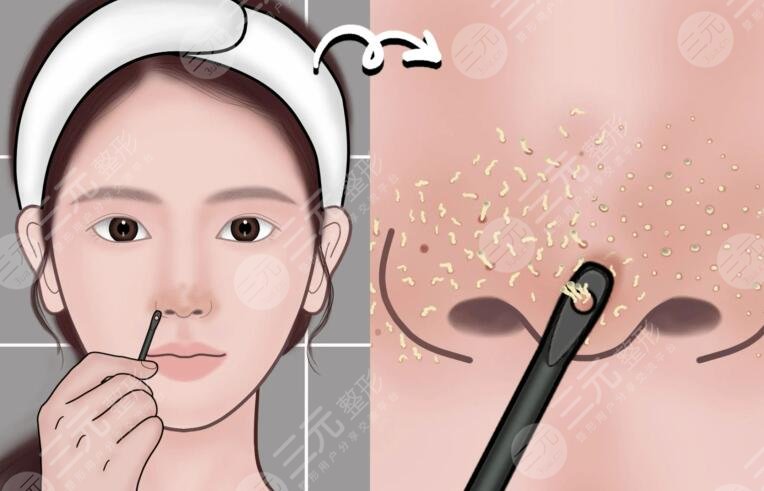 蘇打水去黑頭的注意事項(xiàng)