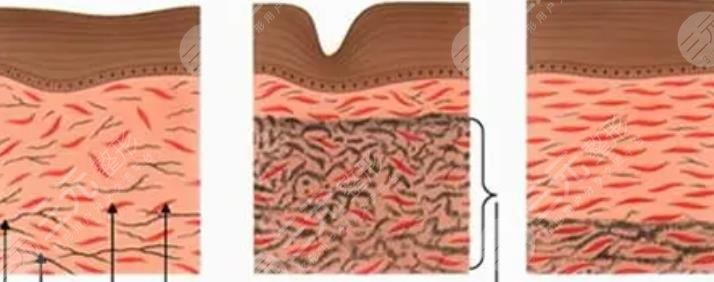 等離子激光溶脂