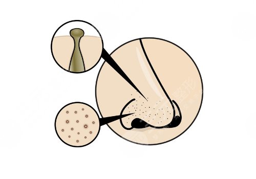 如何去鼻子上的黑頭?