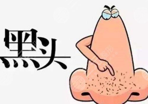 如何去鼻子上的黑頭?