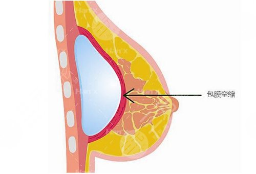 隆胸假體可以放一輩子嗎?