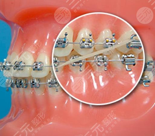 牙齒矯正