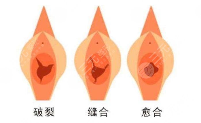 收緊陰道時(shí)的注意事項(xiàng)有哪些