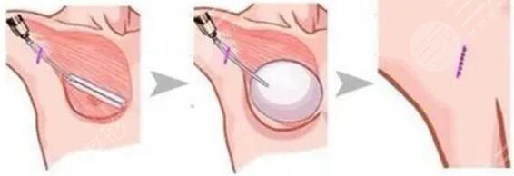 英國娜高假體的優(yōu)勢性