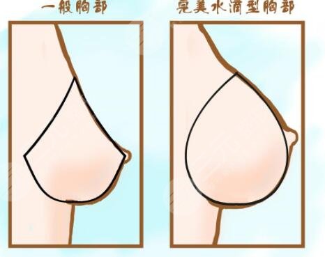 英國娜高假體的優(yōu)勢性