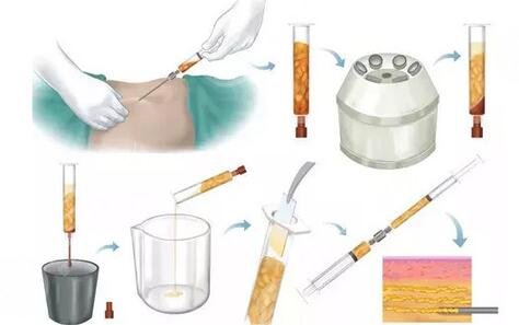 抽脂肪之后需要做好哪些護(hù)理工作?