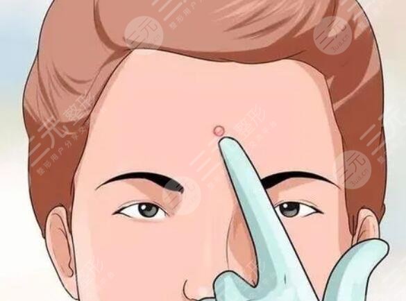 北京緩解痤瘡后應(yīng)該注意什么？