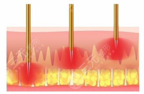 去紅痘印術(shù)前要準(zhǔn)備什么工作?