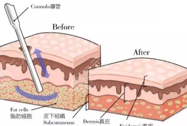 水動(dòng)力吸脂