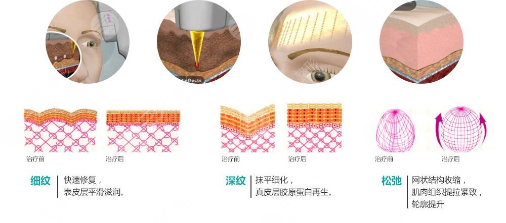 復(fù)合彩光緩解多少錢？