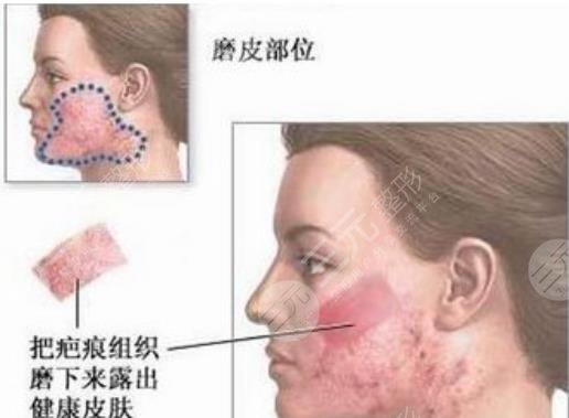 皮膚磨削術(shù)