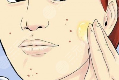 光子去痘手術(shù)注意事項